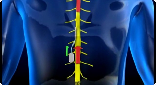 Un implant électronique dans la colonne vertébrale pour maitriser la douleur.