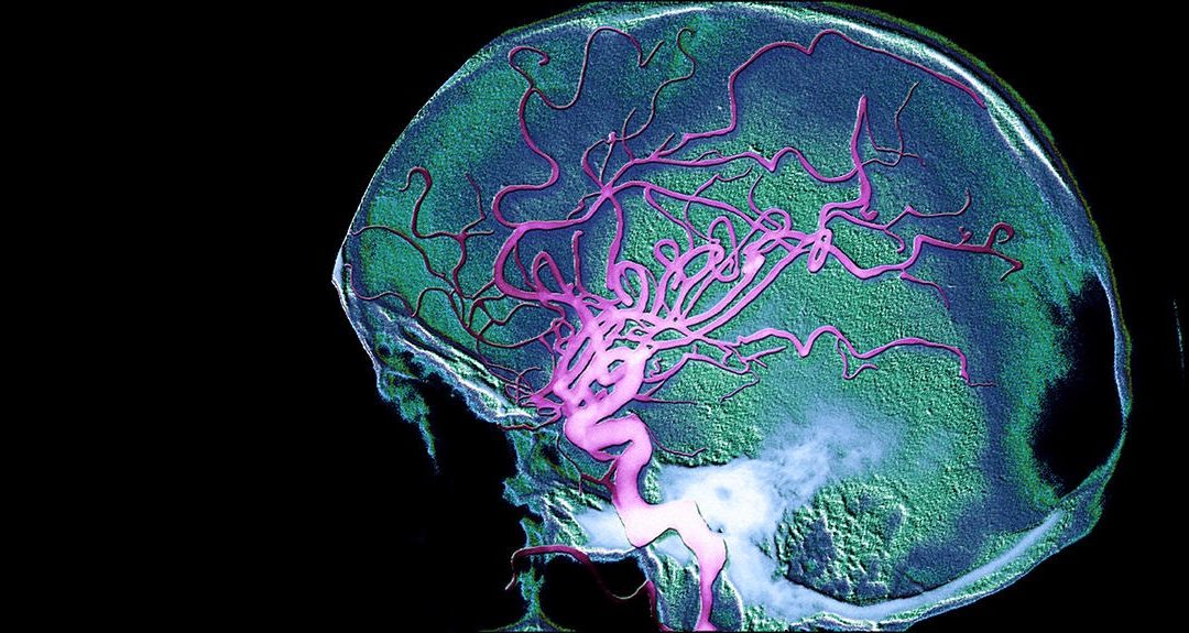 La maladie d’Alzheimer serait-elle transportée par le sang jusqu’au cerveau ?