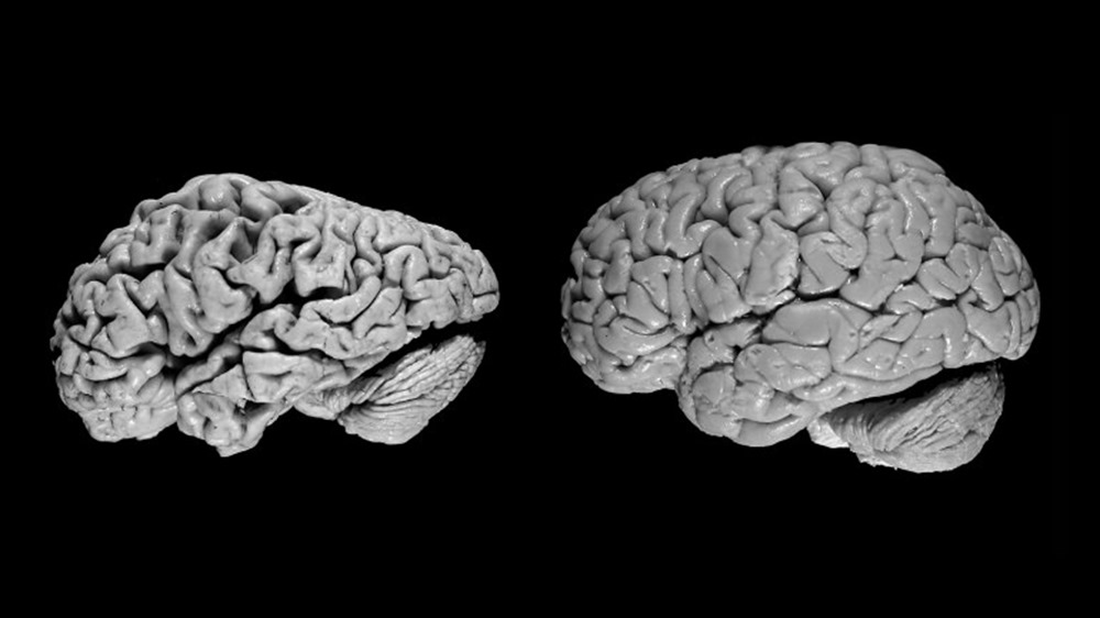 Une intelligence artificielle détecte la maladie d’Alzheimer 6 ans avant un diagnostic humain