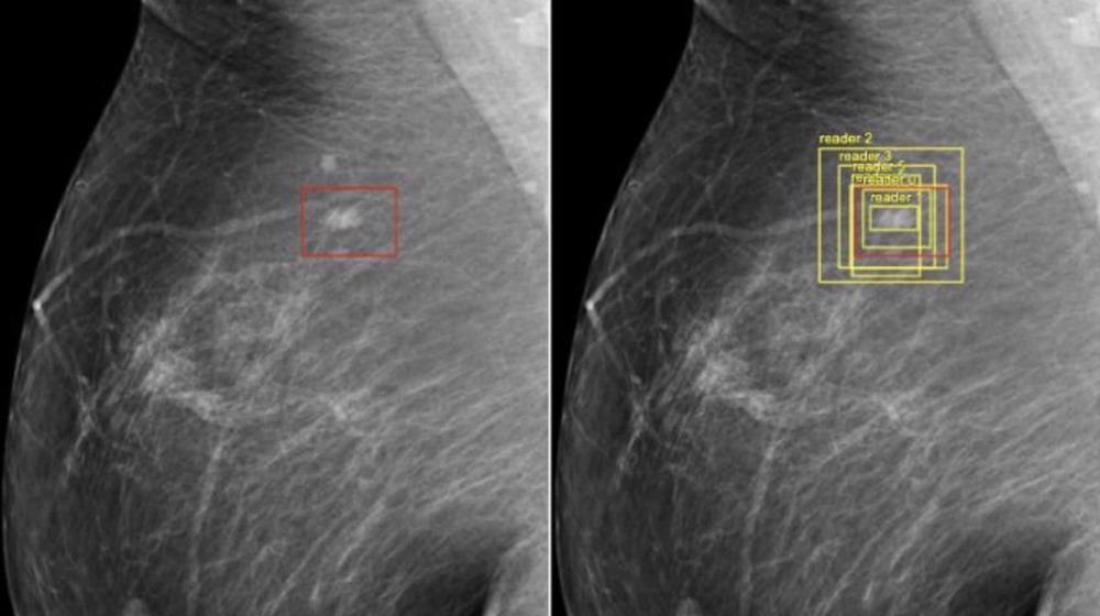 La nouvelle Intelligence Artificielle de Google peut détecter un cancer du sein aussi bien, si ce n’est mieux, que les radiologues