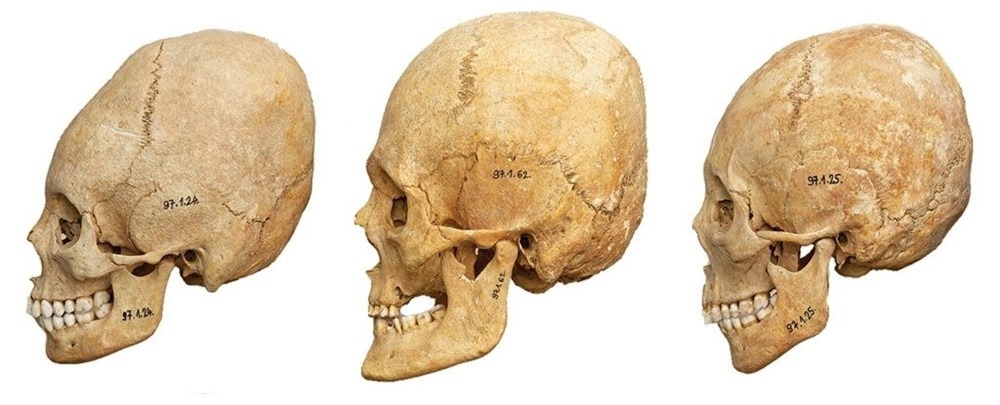 Des crânes déformés offrent des indices sur la vie suite à l’effondrement de l’Empire romain
