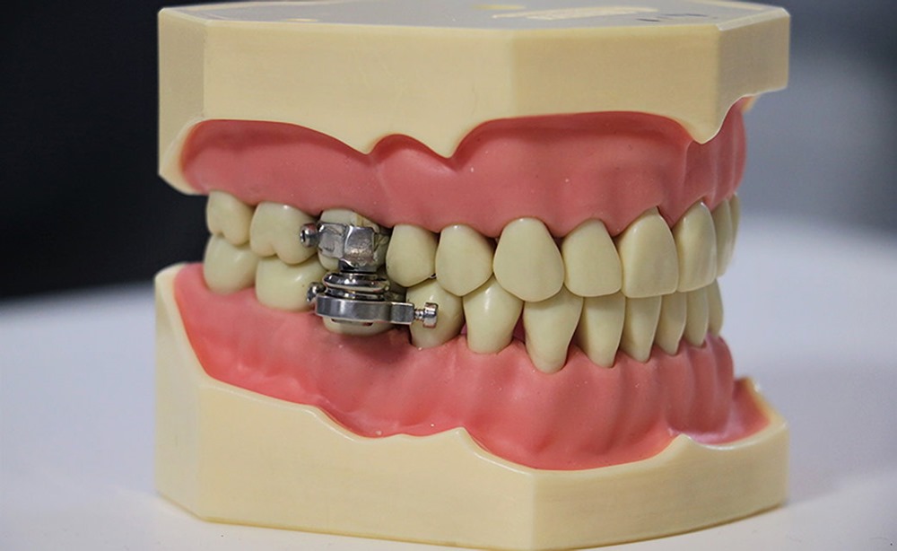 Un nouveau dispositif d’amaigrissement bloque littéralement vos dents avec un verrou métallique