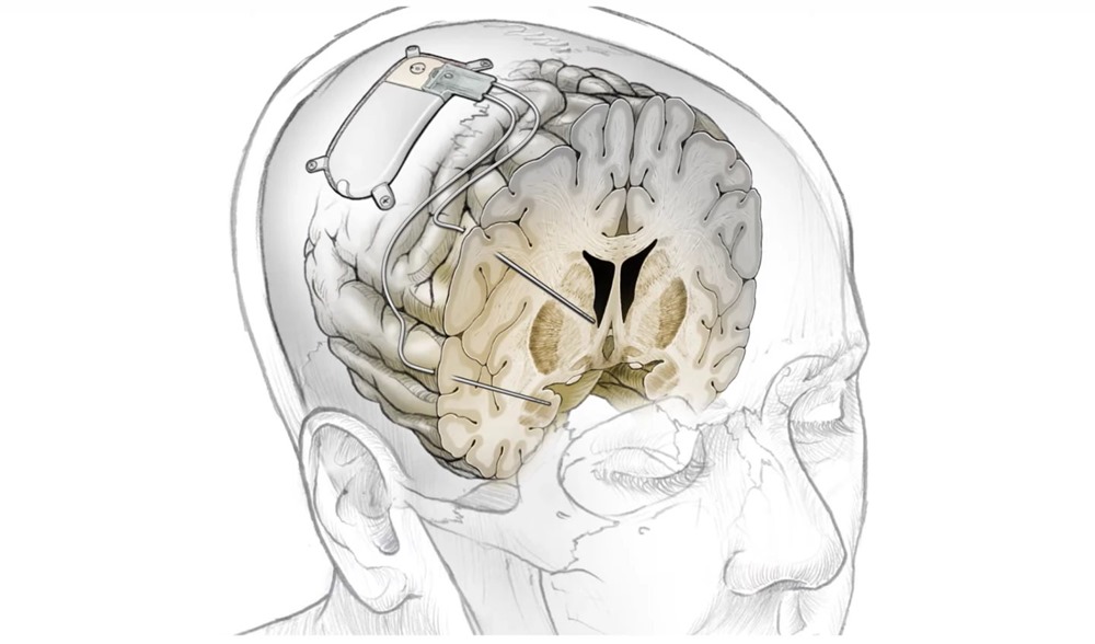 Des scientifiques mettent fin à la profonde dépression d’une patiente grâce à un implant cérébral personnalisable