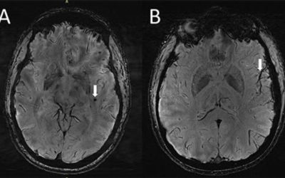 Une analyse d’images IRM révèle des zones inexplorées dans le cerveau de personnes souffrant de migraine